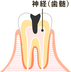 歯の神経まで及んだ虫歯