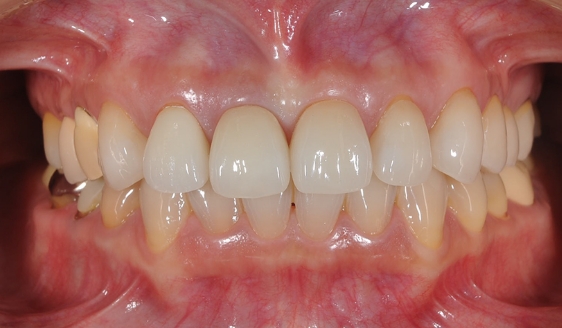 セラミック治療 / 上顎前歯６本 術後