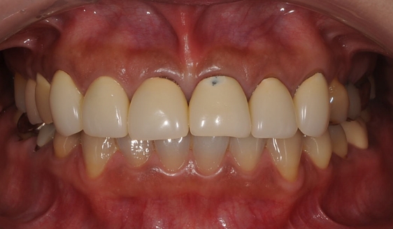 セラミック治療 / 上顎前歯６本 術前