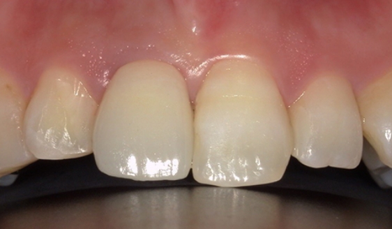 セラミック治療＋インプラント治療 / 右上前歯１本 術後