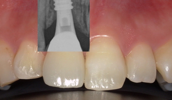 セラミック治療＋インプラント治療 / 右上前歯１本 術後