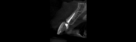 セラミック治療＋インプラント治療 / 右上前歯１本 術前