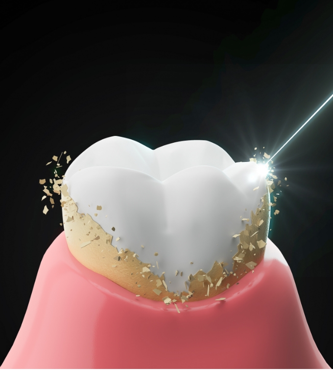 歯石除去の目的