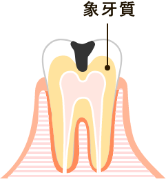 象牙質に及んだ虫歯